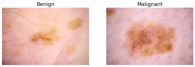 Example images of benign versus malignant skin lesions